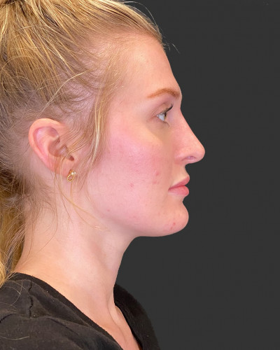 After Image: Nasal Filler - front