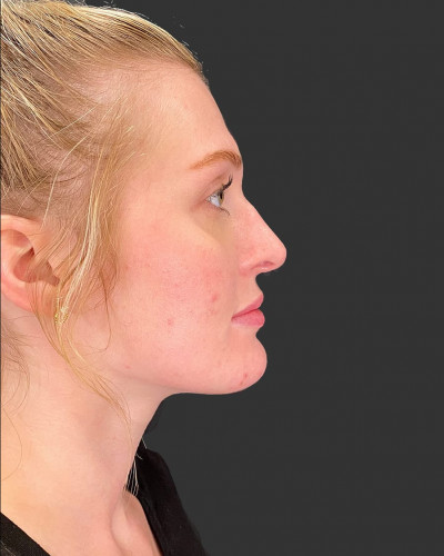 Before Image: Nasal Filler - front