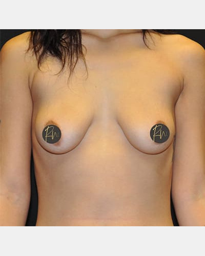 Before Image: Case #5565 – Breast Augmentation - front