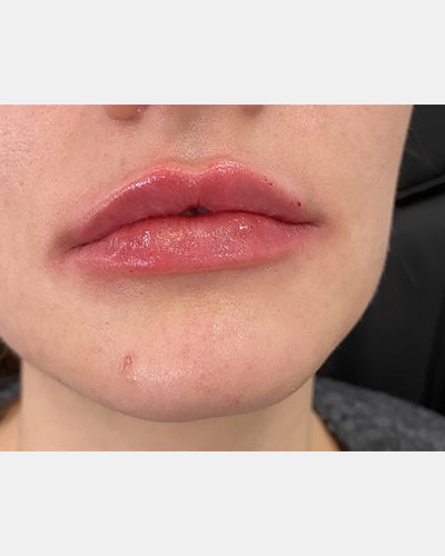 Lip Filler Revision