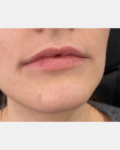 Lip Filler Revision