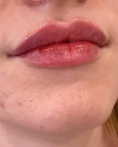 Lip filler by Jackie Jacinto, RN
