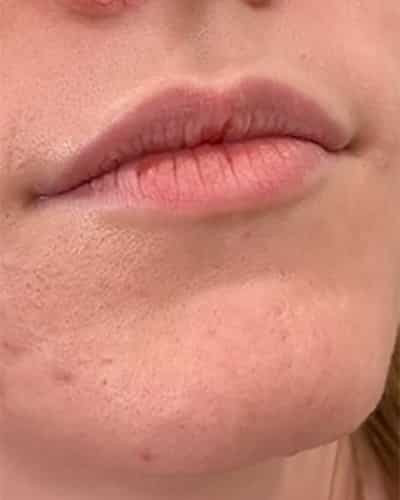 Lip filler by Jackie Jacinto, RN