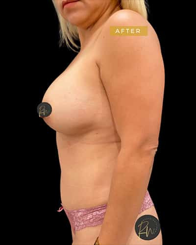 After Image: Breast Augmentation - left-side