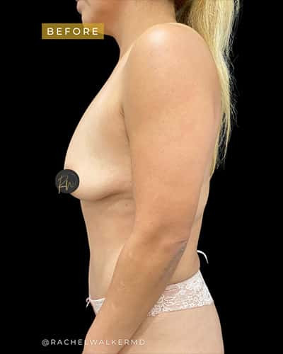 Before Image: Breast Augmentation - left-side