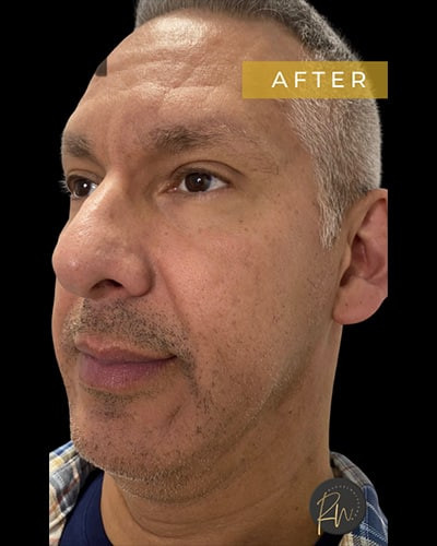 After Image: Case #5880 – Multimodality Laser Scar Resurfacing and Filler Placement - left-front-oblique