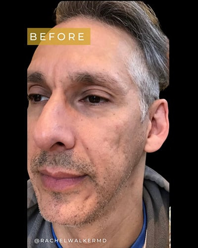Before Image: Case #5880 – Multimodality Laser Scar Resurfacing and Filler Placement - left-front-oblique