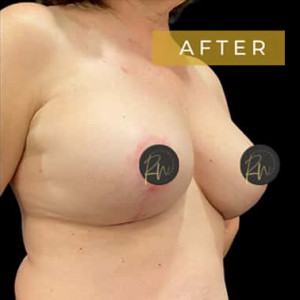 After Image: Case #5883 – Breast Lift (no implant) - right-front-oblique