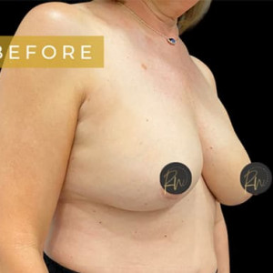 Before Image: Case #5883 – Breast Lift (no implant) - right-front-oblique