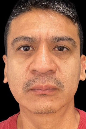 After Image: Case #6043 – Eyelid Surgery - front