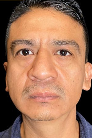 Before Image: Case #6043 – Eyelid Surgery - front