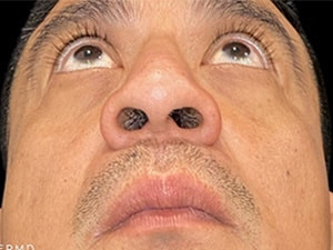 After Image: Case #6043 – Eyelid Surgery - other