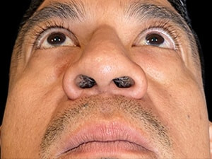 Before Image: Case #6043 – Eyelid Surgery - other