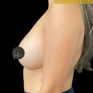 Case #6046 – Breast Augmentation