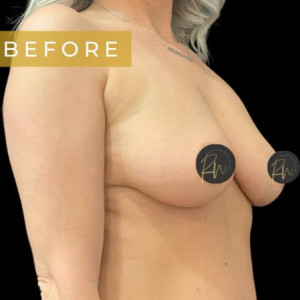 Before Image: Case #6070 – Breast Augmentation - right-front-oblique