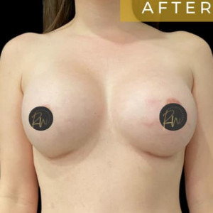 Case #6071 – Breast Augmentation