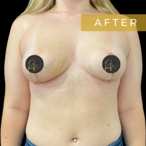 After Image: Case #6094 – Breast Asymmetry - front