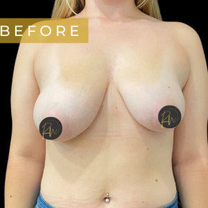 Before Image: Case #6094 – Breast Asymmetry - front