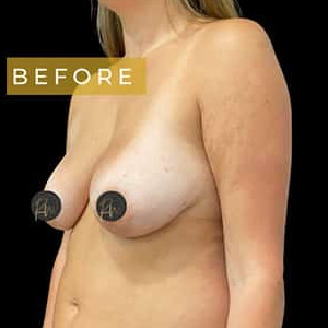 Before Image: Case #6120 – Breast Lift (no implant) - left-front-oblique