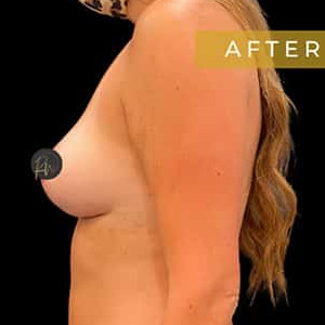 After Image: Case #6120 – Breast Lift (no implant) - left-side