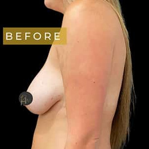 Before Image: Case #6120 – Breast Lift (no implant) - left-side