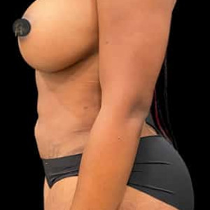 After Image: Case #6132 – Breast Augmentation - other