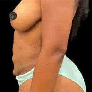 Before Image: Case #6132 – Breast Augmentation - other