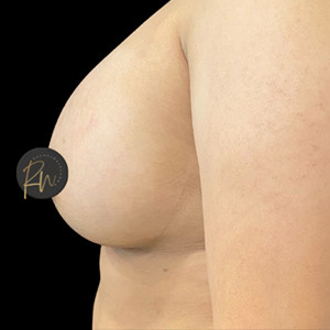 Case #6187 – Breast Augmentation