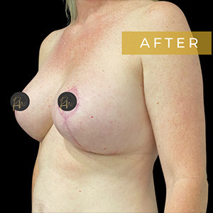 After Image: Case #6206 – Breast Lift with Breast Augmentation - left-front-oblique