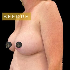 Before Image: Case #6206 – Breast Lift with Breast Augmentation - left-front-oblique