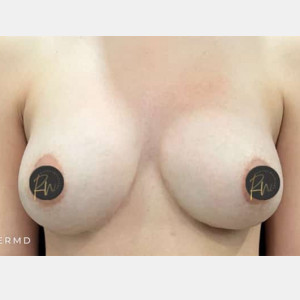 After Image: Case #6236 – Breast Revision/Correction - front