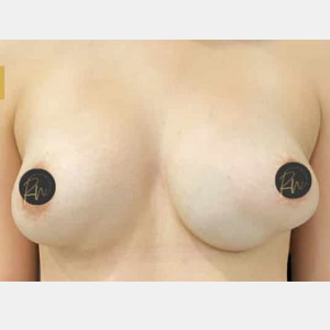 Before Image: Case #6236 – Breast Revision/Correction - front