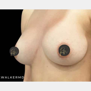 After Image: Case #6236 – Breast Revision/Correction - left-front-oblique