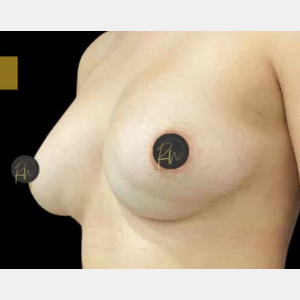 Before Image: Case #6236 – Breast Revision/Correction - left-front-oblique