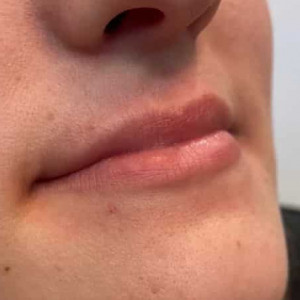 Lip Augmentation