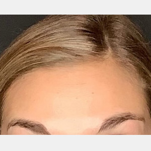 After Image: Case #6273 – Botox - other
