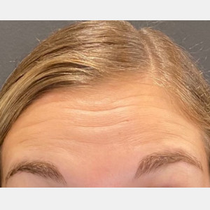 Before Image: Case #6273 – Botox - other