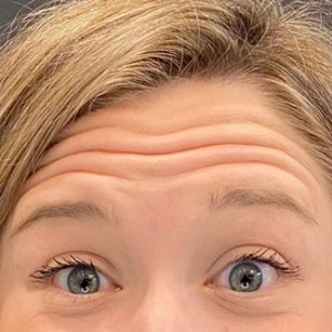 Before Image: Case #6273 – Botox - other