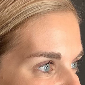 After Image: Case #6273 – Botox - right-front-oblique