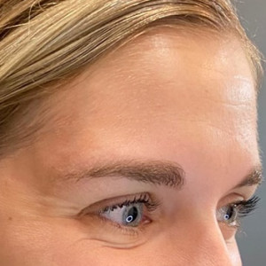 Before Image: Case #6273 – Botox - right-front-oblique