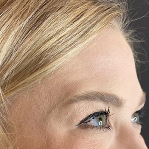 After Image: Case #6273 – Botox - right-front-oblique