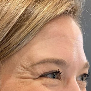 Before Image: Case #6273 – Botox - right-front-oblique