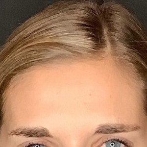 After Image: Case #6274 – Botox - other