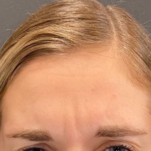 Before Image: Case #6274 – Botox - other