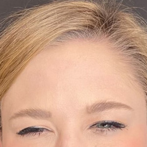 After Image: Case #6274 – Botox - other