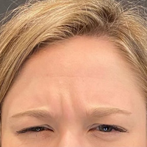 Before Image: Case #6274 – Botox - other