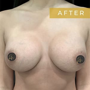 Case #6296 – Breast Augmentation