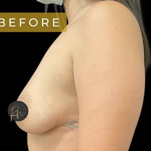 Before Image: Case #6296 – Breast Augmentation - other
