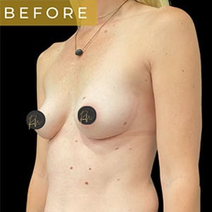 Before Image: Case #6297 – Breast Augmentation - left-front-oblique