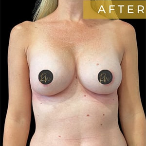 Case #6297 – Breast Augmentation
